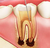 虫歯・根管治療