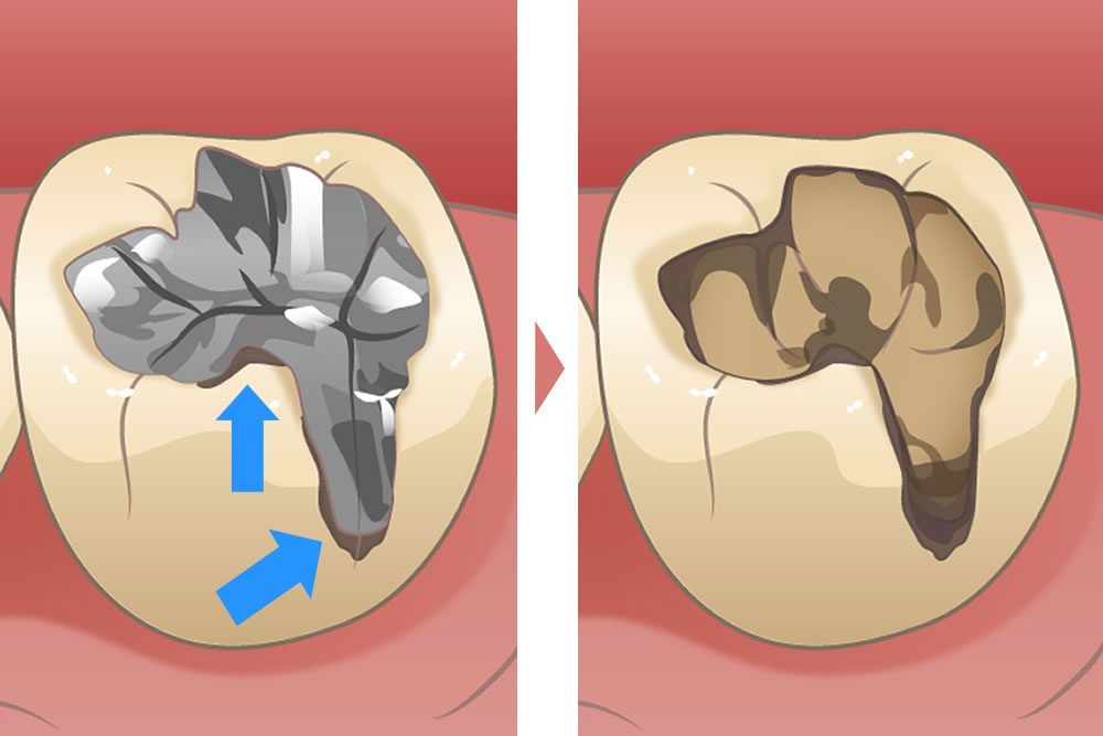 痛く ない 虫歯 治療 すべ きか