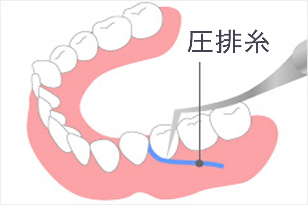 適合性を高めるための歯肉圧排